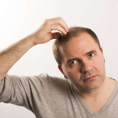 An Essential Guide To Understanding Male Pattern Baldness