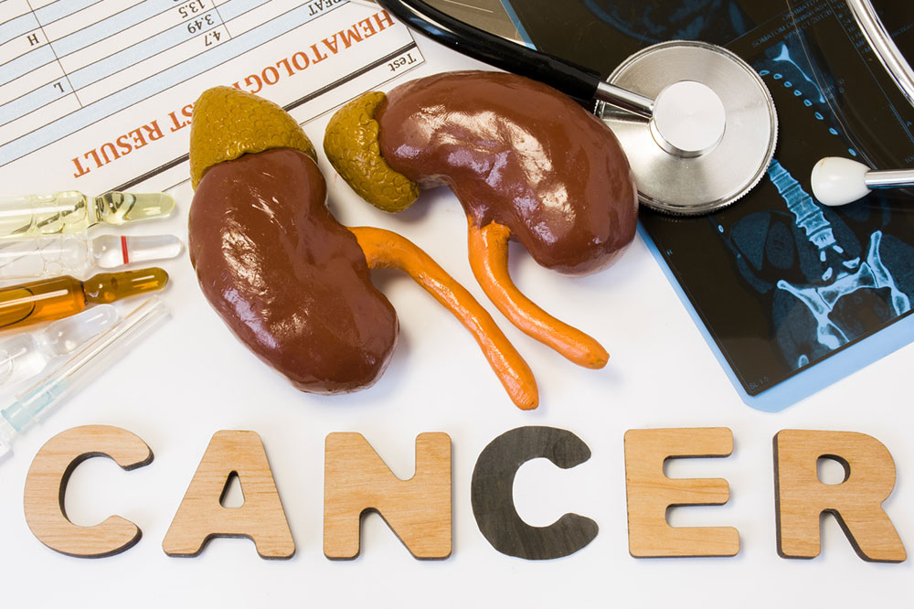 Symptoms and Risk Factors for Kidney Cancer