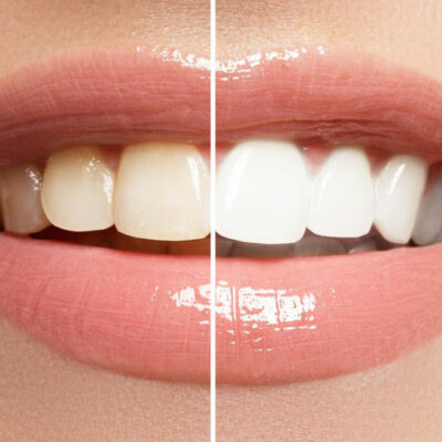 Teeth Whitening Strips for Sparkling Teeth