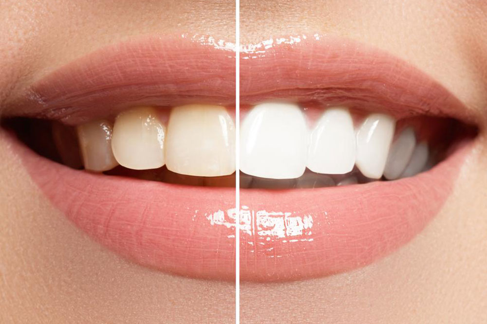 Teeth Whitening Strips for Sparkling Teeth